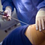 Liposuction Secondary Effects